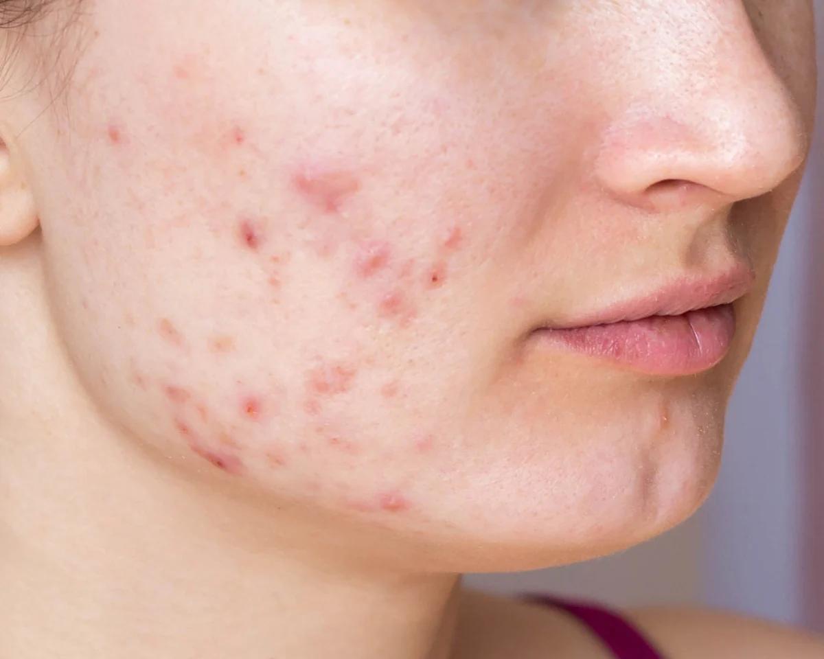 After - Clear healthy skin